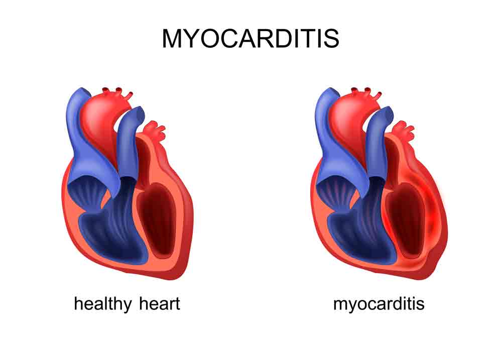 Myocarditis